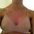 10 Days post-op