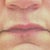 Four days after Vitrase injection in center of top lip