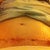 15 days post op