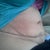 11 weeks post op side siting view :(