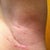 Left incision
