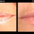No more prune lips after 1 syringe of Juvederm!!!
