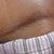 Left side of scar with rash