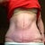 Uneven post op