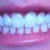 After, no more deep bite and my front teeth are no longer grinding into each other on the inside.
