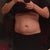 2.5 weeks. Swelling of the fat is still present.