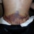 Lower back bruise