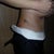 Side shot four days post op