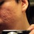 April 27, 2012 - Day before procedure

This is the right side of my face (reflected in a mirror) given the worst possible lighting.