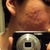 April 27, 2012 - Day before procedure

This is the left side of my face (reflected in a mirror) given the worst possible lighting.