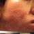 May 9, 2012 - 11 days after procedure

This is the left side of my face (reflected in a mirror) given the worst possible lighting.
