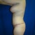 3 months post op