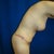 3 months post op