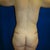 3 months post op