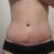1 month post op, wrinkles are from tape