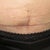 horizontal and vertical scars. there's a hard bulge there ...