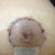 16 days post op