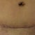 front of my scar and bb you can also see to my right where I almost had my abscess from the fat necrosis.