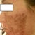 Day 4 Left (peeling)