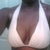 8 mos. post-op