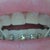 This is the 1st day of having braces.