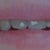 Before Pic.  Right side smile