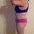 10 days post op