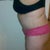 10 days post op