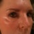 My concern is the indention between my eye and cheek bone