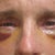 My eyes after surgery ~ you have to work with your lids and keep lubricant on them.