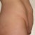 Side View Before Surgery