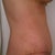 Side View After Surgery 4 Weeks healed