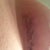 One of my incisions, 1wk post-op (tape still in place)