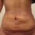2 weeks post op