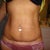 1 month post op. Still uneven swollen and no sign for flat stomach.