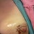 Frankenboob - post bobie biopsy pic. day 2.  5days till mommy makeover.