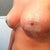 15 days post op oblique