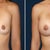 This is the picture I showed my PS and said I wanted to look like. He pointed out that they aren't exactly even (but neither are mine...) The nipples are completely different (I didn't take that into account....) but I think mine will actually end up looking better than this pic. :)