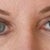 Eyes after surgery-approx 3 months post op