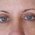 eyes almost 4 months post op.  Dont think they will improve much more according to 3 doctors I've seen already. This was taken April 213