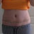 15 days post op