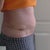 15 days post op