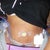 This was 1 Day Post Op.