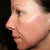 Day #5 left side - skin is more even color now, but hard to tell if it has smoothed the skin much.  I'm not sure when I should start noticing the scars smoothing  out more.
