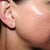 Day #5 Right side - again, hard to tell how much skin is smoothing but color is getting more even.