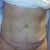 Pre-surgery mark ups for the TT and lipo