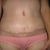 One month post-op