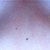 my incisions!