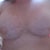 8 WEEKS AFTER SURGERY