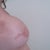 8 WEEKS AFTER SURGERY SIDE VIEW